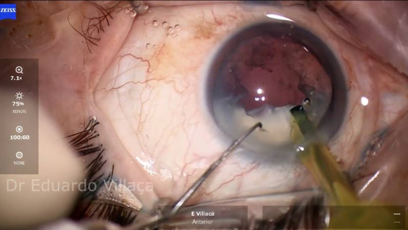 Cirurgia de Descolamento de Retina com Gás Agendar Alphaville - Cirurgia de Vitrectomia São Paulo