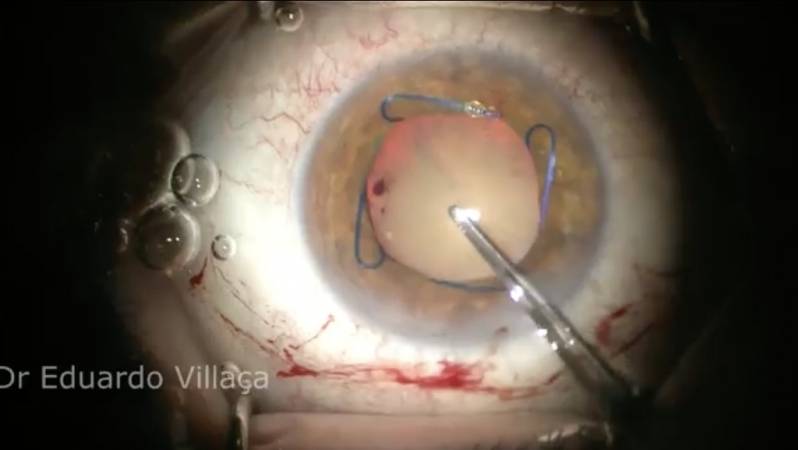 Cirurgia de Descolamento de Retina com Gás Lausane Paulista - Vitrectomia Posterior