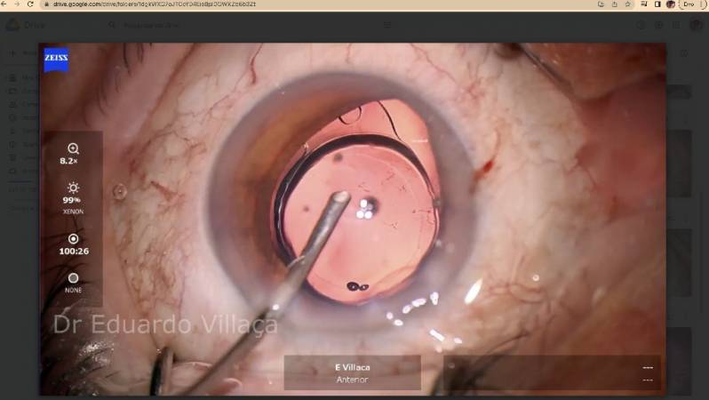 Cirurgia de Retina e Vítreo Agendar Imirin - Cirurgia de Descolamento de Retina com Gás