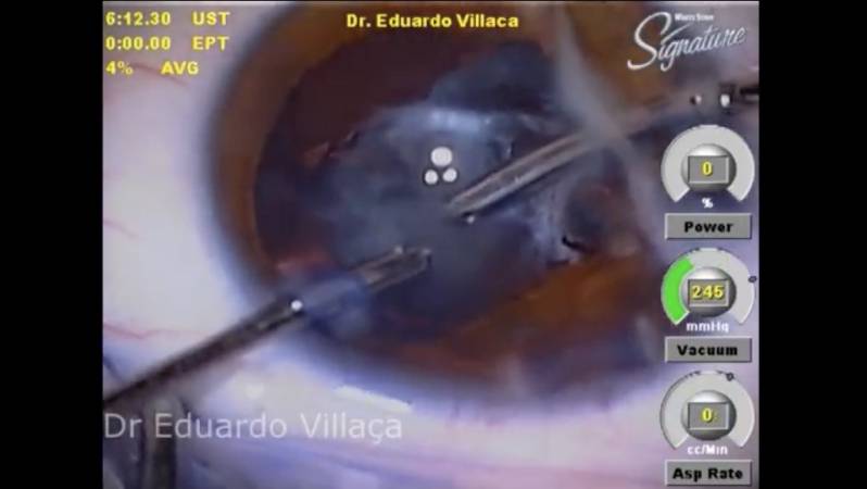 Cirurgia de Vitrectomia Agendar Vila Curuçá - Cirurgia de Vitrectomia