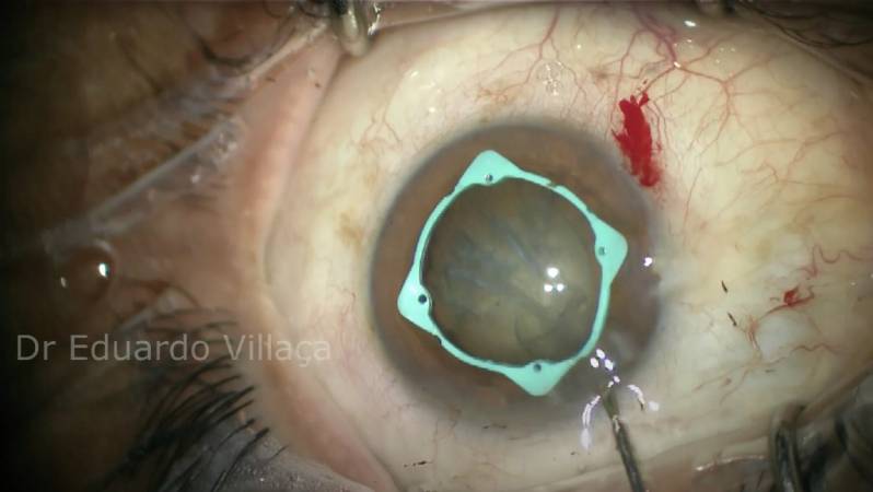 Cirurgia de Vitrectomia com Gás Parque São Jorge - Cirurgia de Descolamento de Retina com Gás