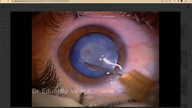 Cirurgia de Vitrectomia com óleo de Silicone Agendar Real Parque - Vitrectomia Posterior