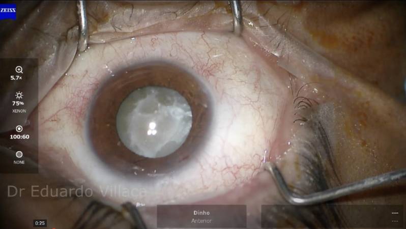 Cirurgia de Vitrectomia com óleo de Silicone Cidade Centenário - Cirurgia Vitrectomia Posterior