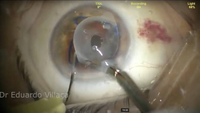 Cirurgia de Vitrectomia Posterior Agendar Higienópolis - Cirurgia de Vitrectomia com óleo de Silicone