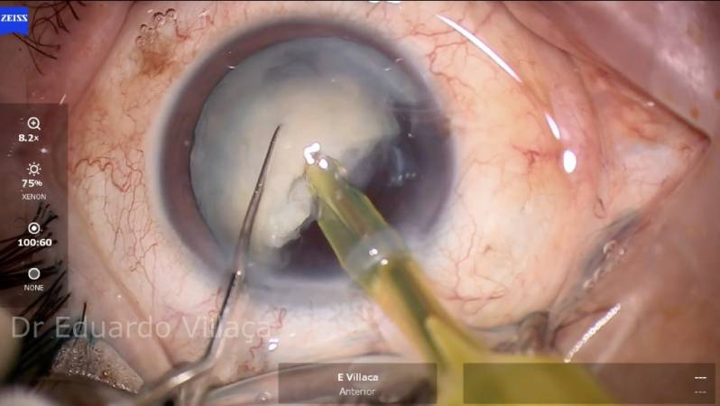 Cirurgia de Vitrectomia Posterior Anália Franco - Cirurgia de Retina e Vítreo