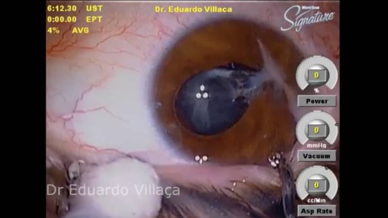 Cirurgia de Vitrectomia Jardim Vera Cruz - Cirurgia de Retina e Vítreo