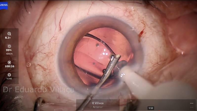 Cirurgia Retina Vitrectomia Agendar Sorocaba - Cirurgia de Vitrectomia