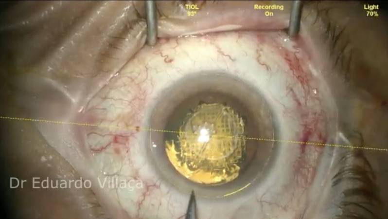 Cirurgia Vitrectomia Agendar Vila Romero - Cirurgia de Vitrectomia São Paulo