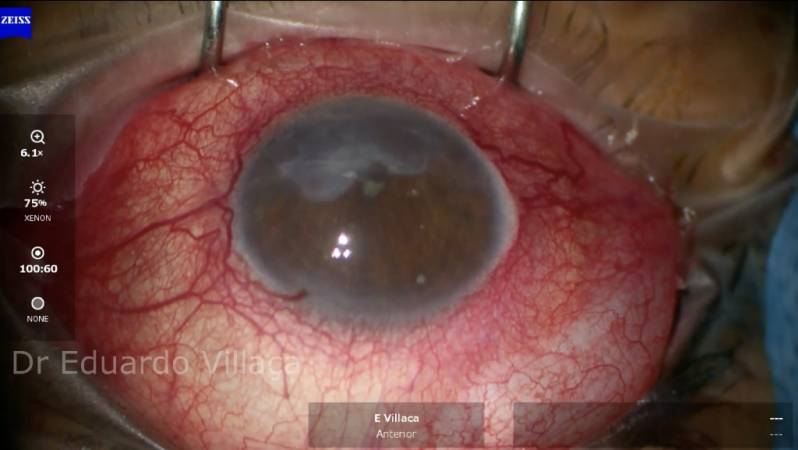 Cirurgia Vitrectomia Posterior Marcar Zona Oeste - Cirurgia Vitrectomia Posterior