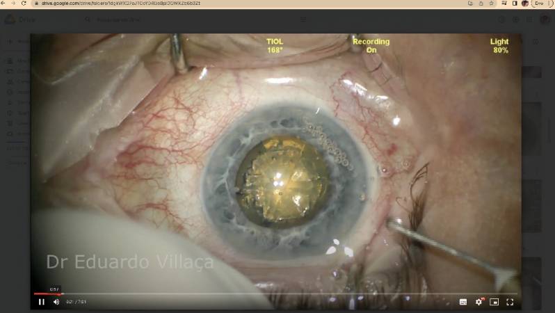 Cirurgia Vitrectomia Posterior Vila Santista - Cirurgia de Descolamento de Retina com Gás