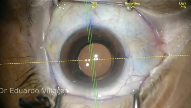 Clínica Especializada em Cirurgia de Retina e Vítreo Itaquaquecetuba - Cirurgia Vitrectomia Posterior