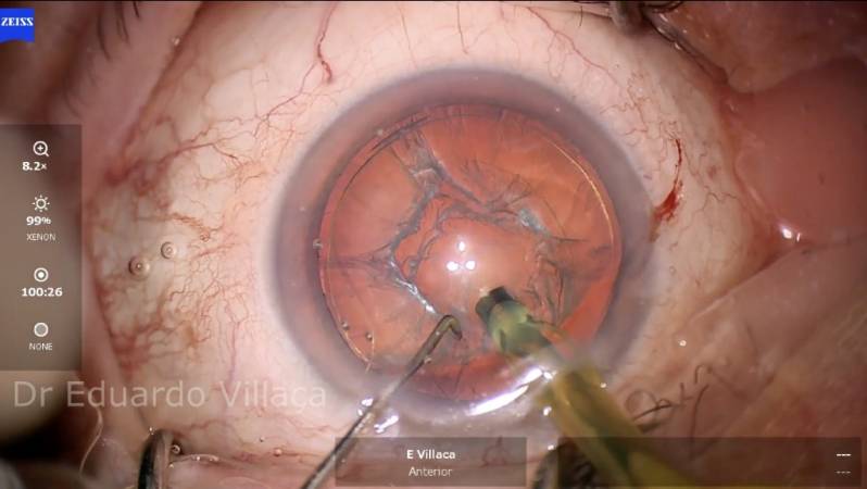 Clínica Especializada em Cirurgia de Vitrectomia com Gás Zona Norte - Cirurgia de Descolamento de Retina com Gás