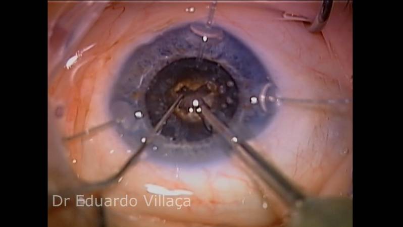 Clínica Especializada em Cirurgia de Vitrectomia com óleo de Silicone Ribeirão Pires - Vitrectomia Posterior