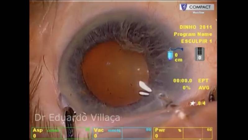 Clínica Especializada em Cirurgia Vitrectomia Posterior Alphaville - Cirurgia de Vitrectomia São Paulo