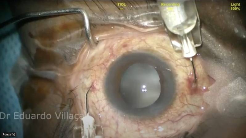 Clínica Que Faz Cirurgia de Vitrectomia Posterior Imirim - Cirurgia de Vitrectomia com Gás