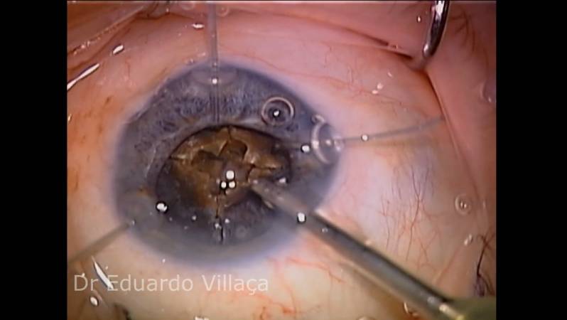 Clínica Que Faz Cirurgia Vitrectomia Jardim Tietê - Cirurgia de Vitrectomia