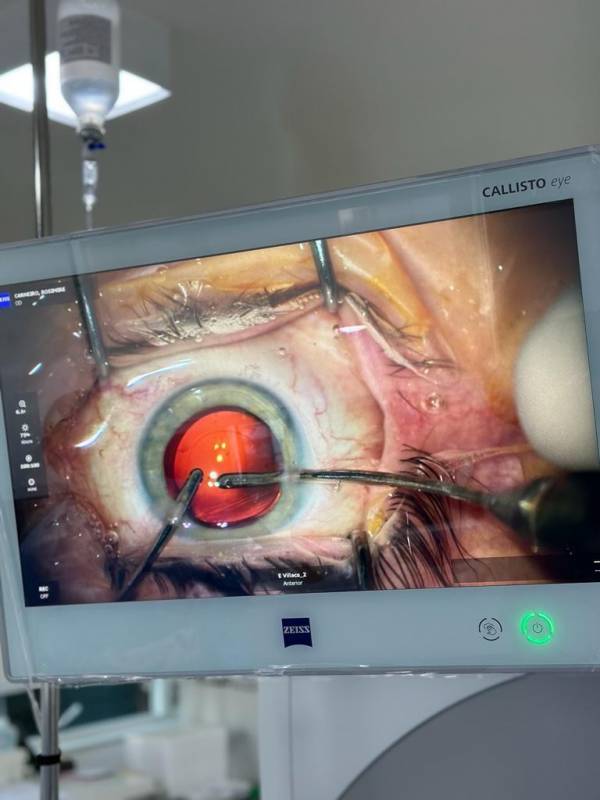 Onde Marcar Médico Especialista em Cirurgia de Catarata Jabaquara - Médico Especialista em Facectomia