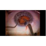 cirurgia catarata facectomia agendar bras leme