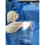 cirurgia catarata laser marcar Santo Amaro