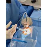 cirurgia de catarata a laser Moema