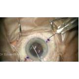 cirurgia de catarata com implante de lente multifocal marcar Água Funda