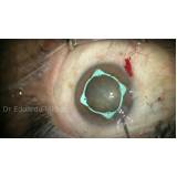 cirurgia de catarata com lente multifocal Pompéia