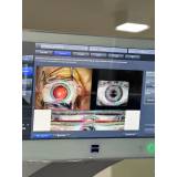 cirurgia de catarata laser Jardins