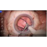 cirurgia de catarata precoce marcar Jaçanã