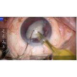 cirurgia de lente intraocular agendar Morumbi