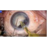 cirurgia de lente intraocular Jarinu