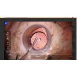 cirurgia de retina e vítreo agendar imirin