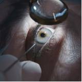 cirurgia nos olhos para não usar mais óculos Tatuapé