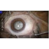 cirurgia para colocação de lente intraocular Alphaville