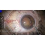 cirurgia para colocar lente nos olhos Vila Curuçá