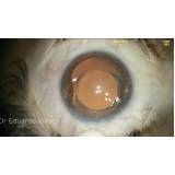 Cirurgia para Colocar Lente Intraocular