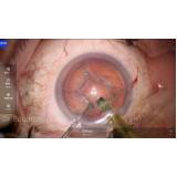 clínica especializada em cirurgia de vitrectomia com gás Zona Norte