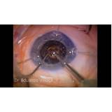 clínica especializada em cirurgia de vitrectomia com óleo de silicone Brasilândia