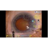 clínica especializada em cirurgia vitrectomia posterior Embu