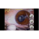 clínica especializada em facectomia com implante de lente Cidade Patriarca