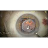 clínica que faz cirurgia de catarata com lente dentro do olho Raposo Tavares