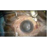 clínica que faz cirurgia de lente intraocular Moema