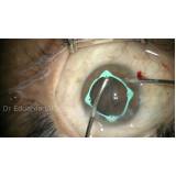 clínica que faz cirurgia de vitrectomia com gás Zona Leste