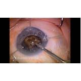 clínica que faz cirurgia vitrectomia Zona Norte