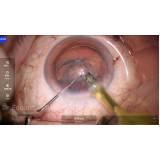 onde agendar cirurgia para colocação de lente intraocular Alto da Lapa