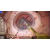 onde fazer cirurgia de catarata com colocação de lente República