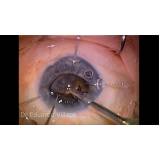 onde fazer cirurgia de catarata com implante Jaçanã