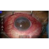 onde marcar cirurgia de catarata glaucoma Lins