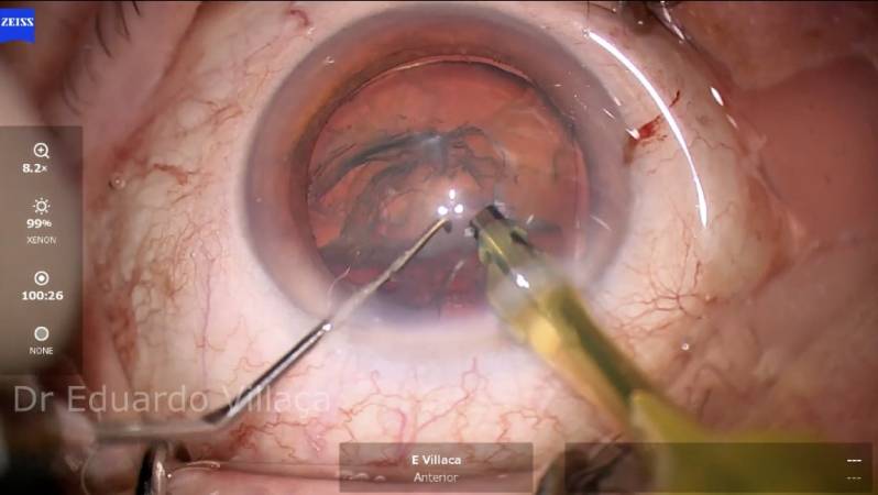 Vitrectomia Posterior Vila Dalila - Cirurgia de Vitrectomia Consolação